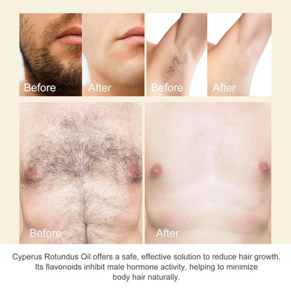 Cyperus Rotundus Oil for Hair Removal