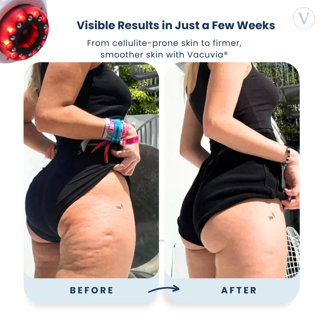 Vacuvia SculptGlow Body Firming Massager