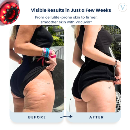 Vacuvia SculptGlow Body Firming Massager