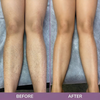 Cyperus Rotundus Oil for Hair Removal