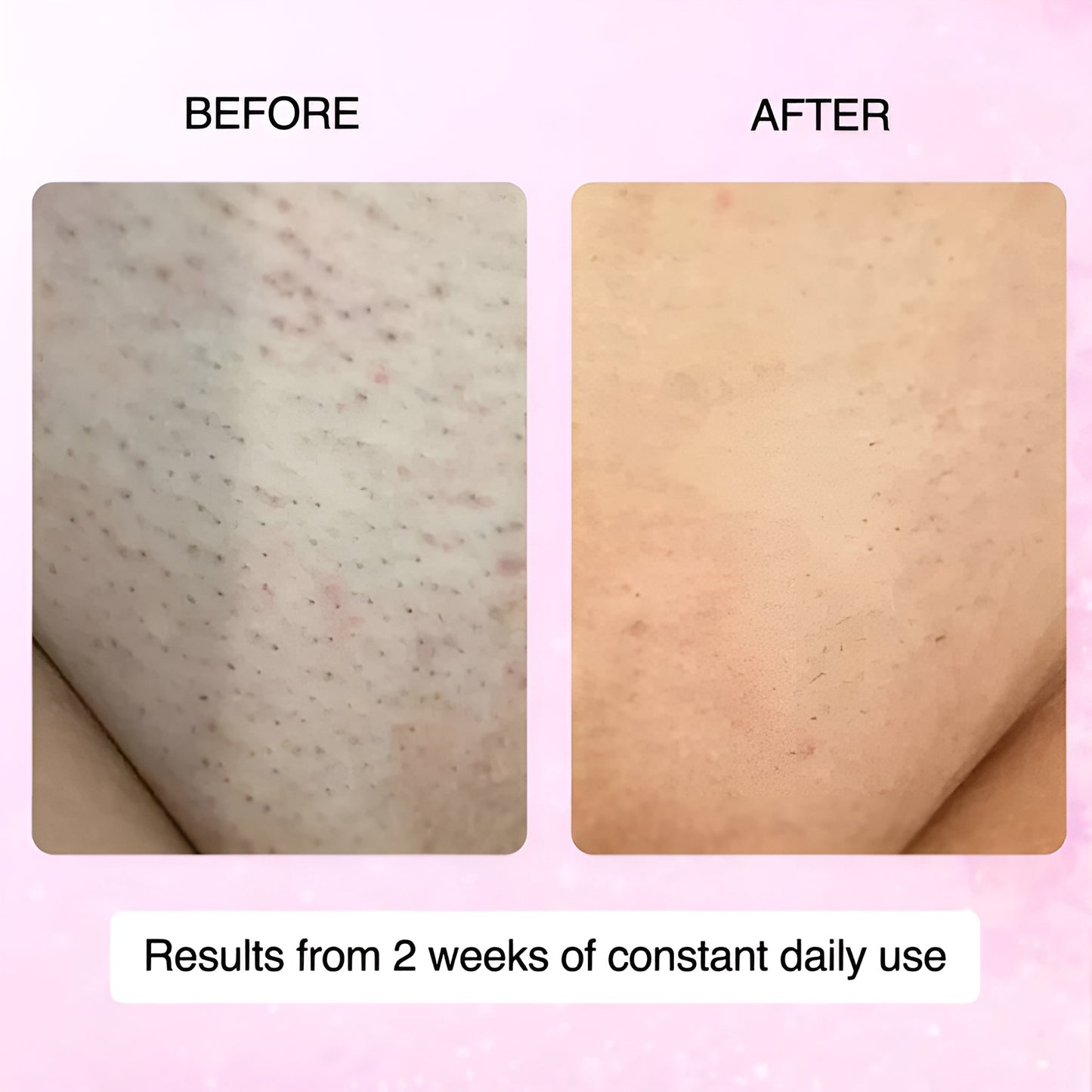 Cyperus Rotundus Oil for Hair Removal